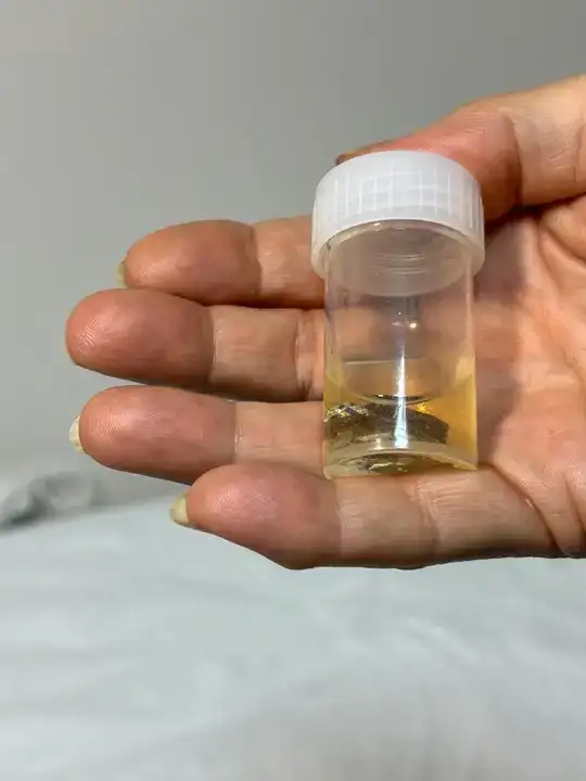 Ambalajıyla Yuttuğu Hap, 4 Yıl Sonra Akciğerinden Çıkarıldı 6